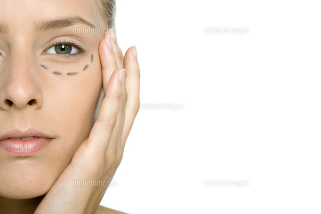 Woman with plastic surgery markings under her eye
(c)Alix Minde/PhotoAlto