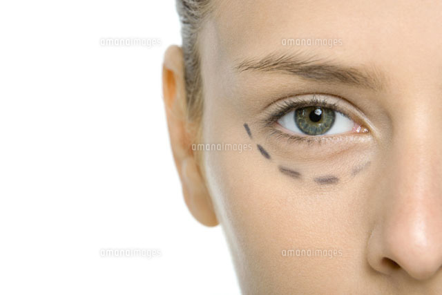 Young woman with plastic surgery markings under eye
(c)Alix Minde/PhotoAlto